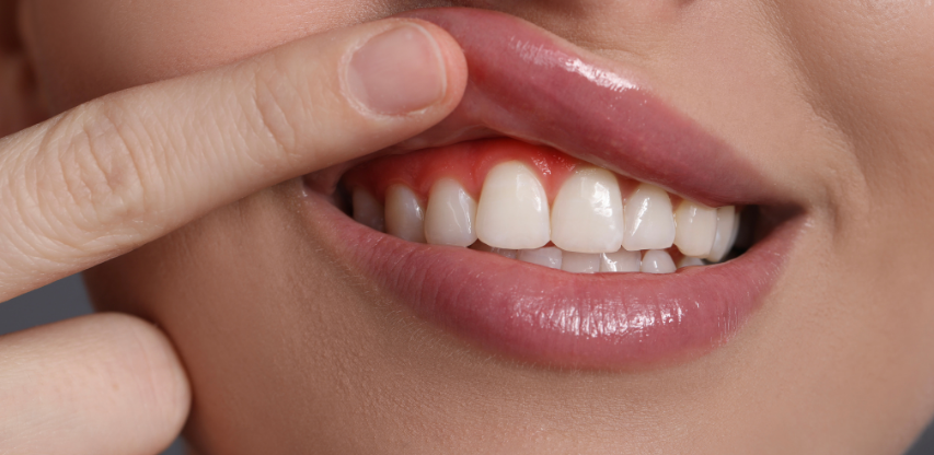 Diş eti hastalığı tedavisi periodontal uygulama