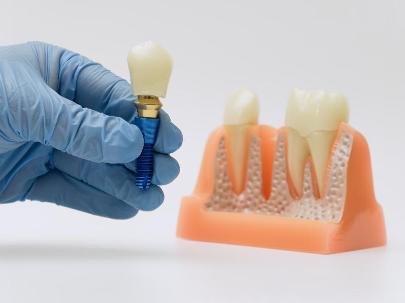 implant sonrası iyileşme süreci ve bakım önerileri