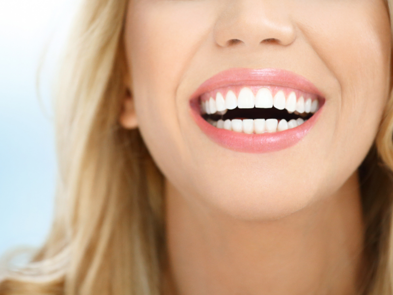 Hollywood Smile gülüş estetiği uygulaması